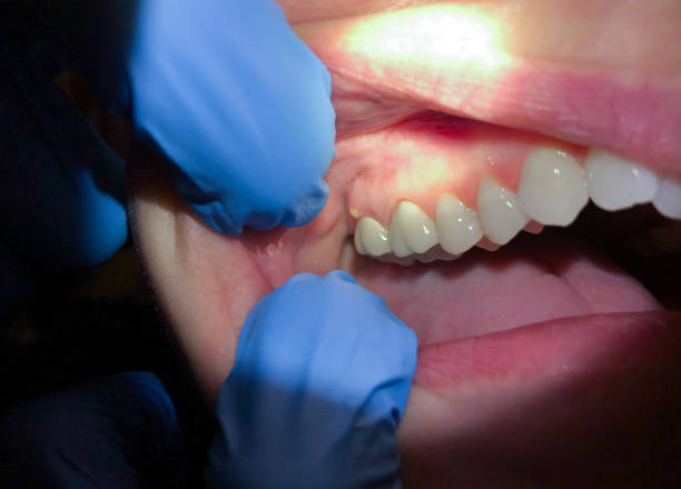 Best Emergency Dental Care for Broken or Chipped Teeth in Henderson, TN